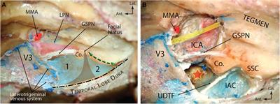 Comprehensive microsurgical anatomy of the middle cranial fossa: Part II—neurovascular anatomy